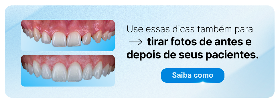 Comparação de dentes antes e depois de um procedimento odontológico, com dicas de fotografia.